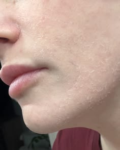 Rough, scaly skin