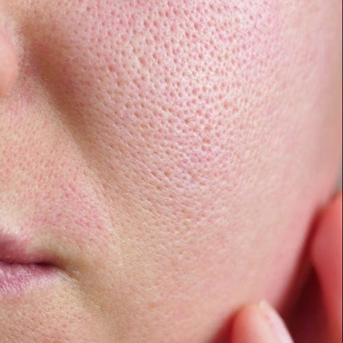 Clogged facial pores