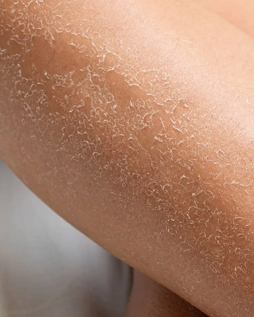 Dry and rough skin
