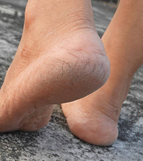 Dry and cracked heels